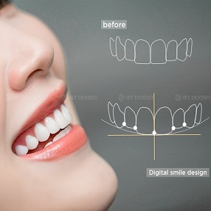 Thiết kế nụ cười hoàn hảo