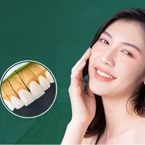 Dịch vụ bọc răng sứ